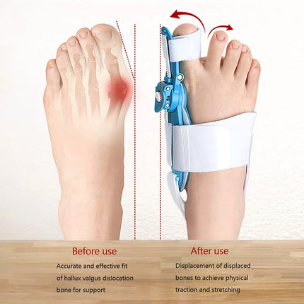 Adjustable Bunion Support Splint â€“ Hallux Valgus Corrector for Men & Women