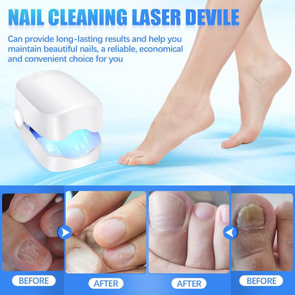 Rechargeable Nail Fungus Laser â€“ Anti-Fungal Device for Toenails, Hands & Feet (Home Use)